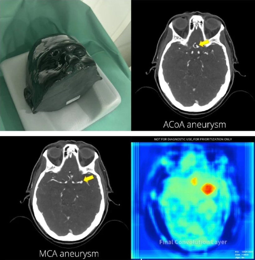 Figure 2. Head phantom with multiple intracranial aneurysms, including...