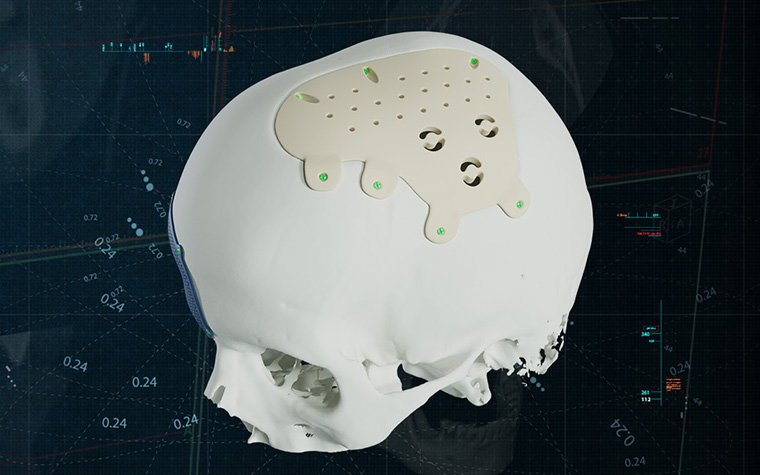 A personalized PEEK skull implant