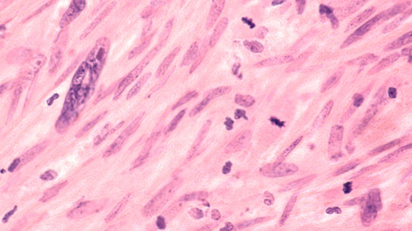 Microscopic image of leiomyosarcoma soft tissue sarcoma