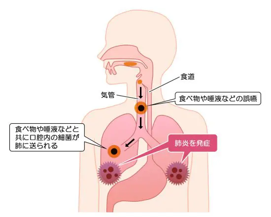 超高齢化社会において注目される「誤嚥性肺炎」とは？ その薬物治療 